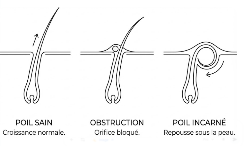 Poil incarné : qu’est-ce que c’est ?